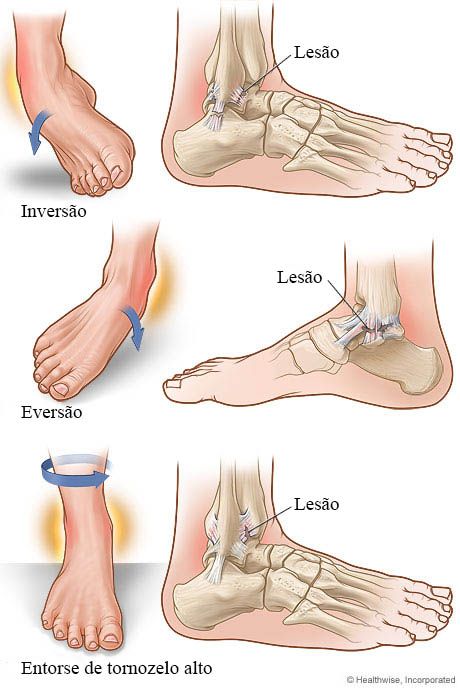 Tornozelo inchado, o que pode ser? 
